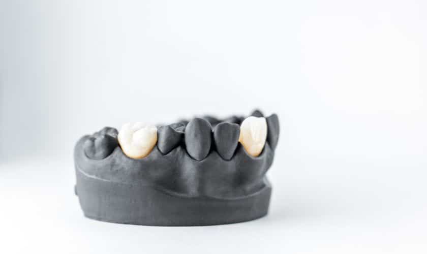 Can a Dental Bridge be Done in One Day?