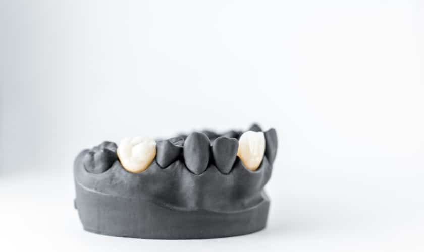 Smile Brighter: An Overview of Dental Crowns for Stronger Teeth