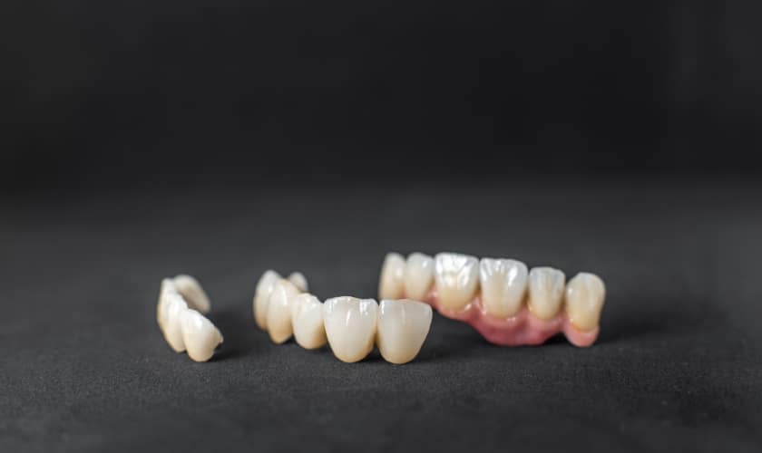 One-Day Dental Bridge: Speedy Smile Restoration