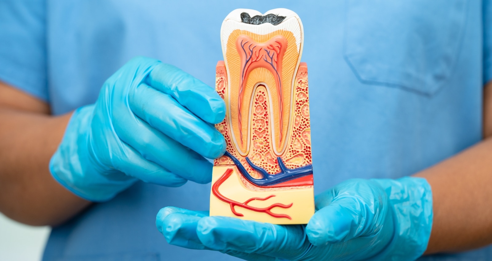 Reasons Why Root Canal Is Ideal for Tooth Preservation