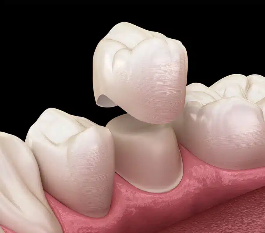 dental crowns chicago il