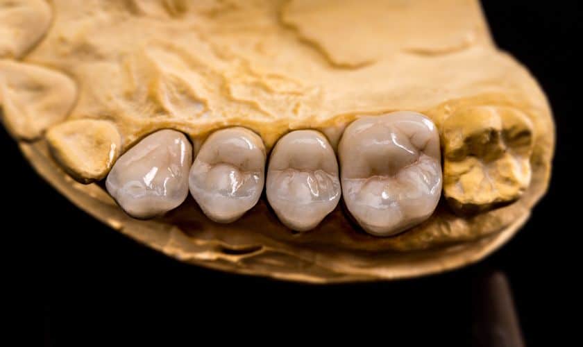 Same-Day Crowns vs Traditional: What to Know