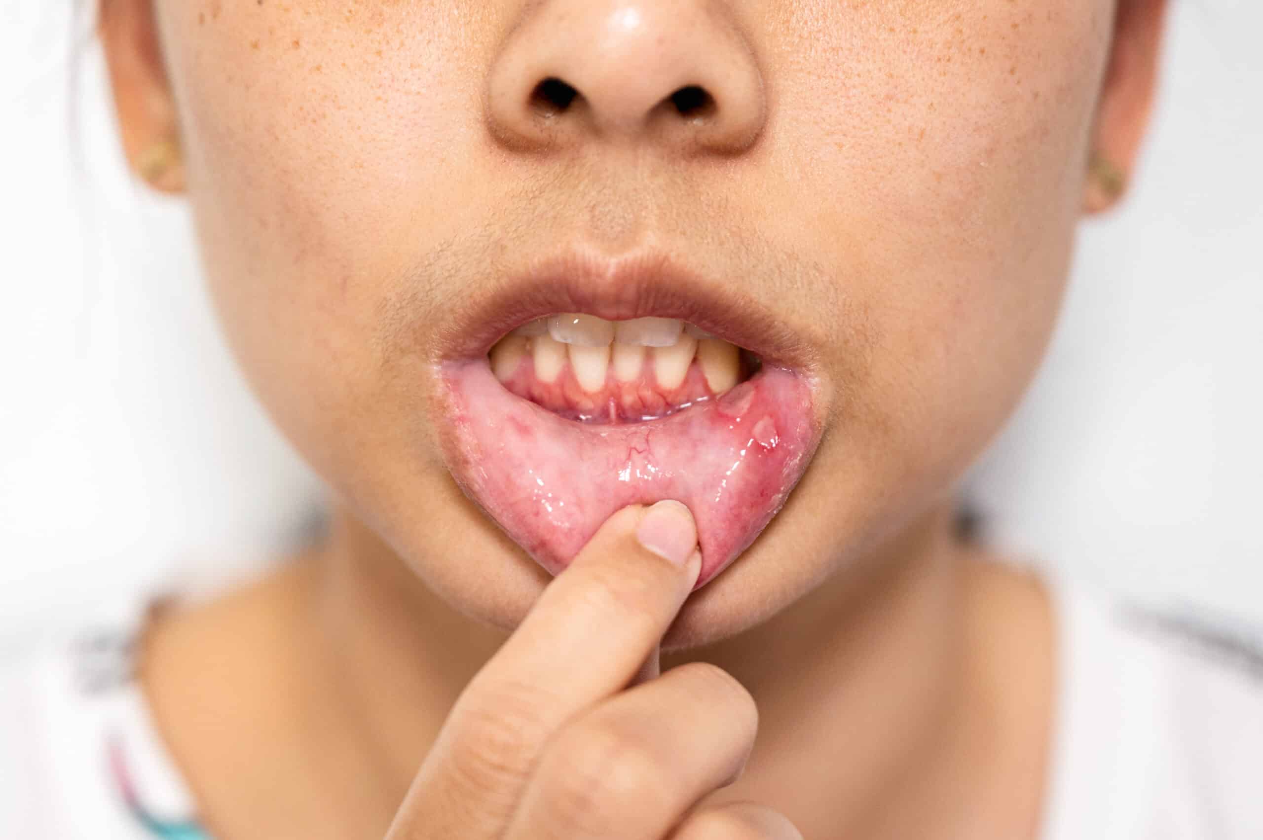 Why are swollen gums and abscesses dental emergencies?