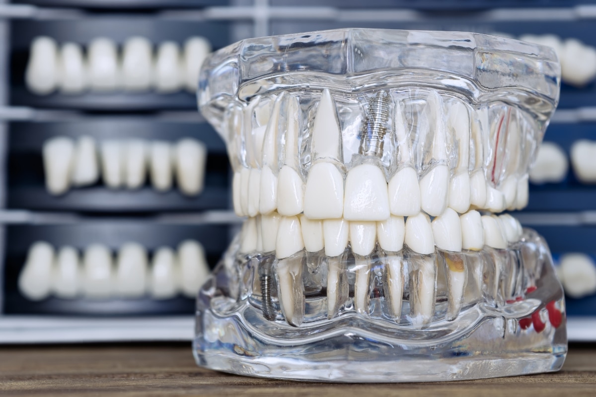 6 Non-Surgical Root Canal Recovery Tips in Chicago