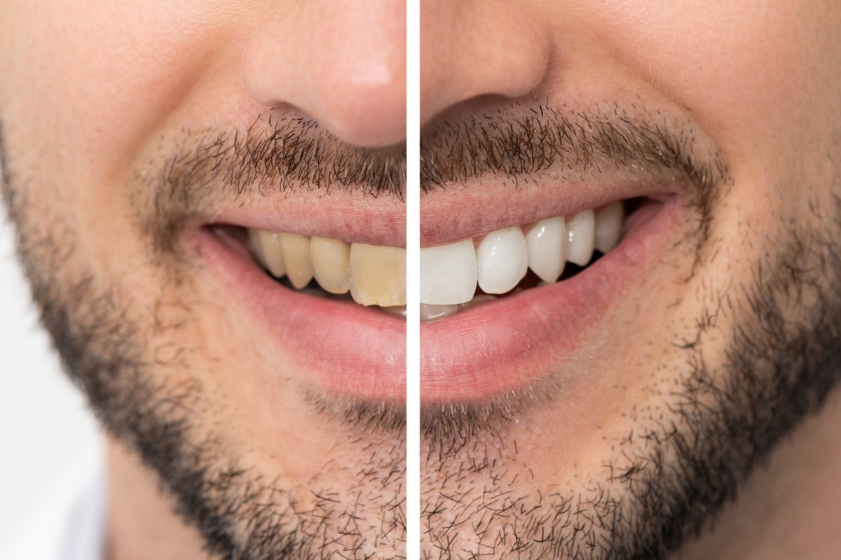 Reverse Rebound Staining After Whitening