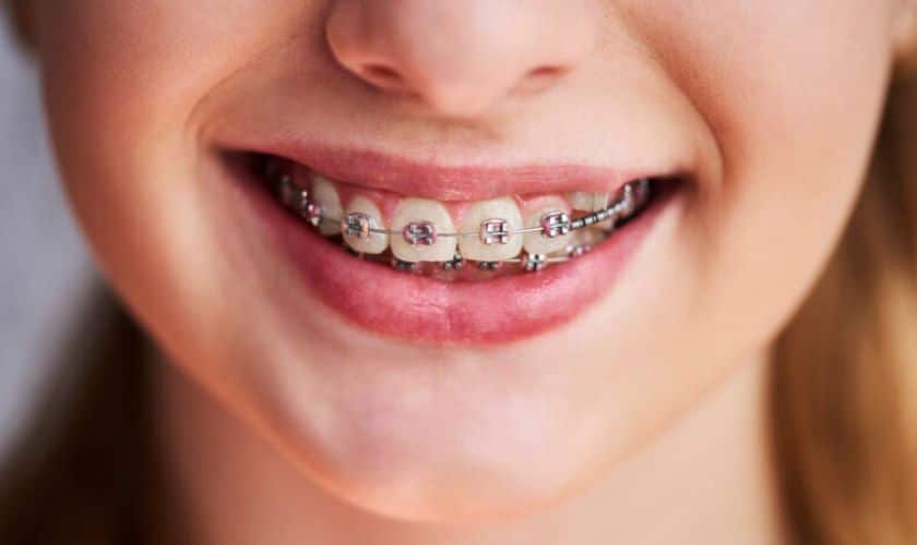 Benefits Of Braces You Didn't Know About