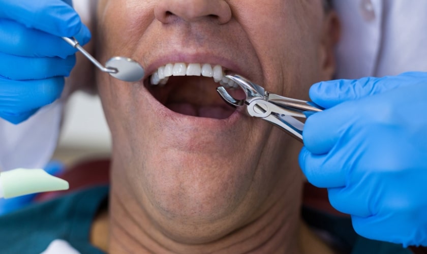 Tips for Tooth Extraction in Chicago , IL