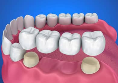 Dental Bridges Treatment in Chicago - InSmyle Dental - Dentist Chicago