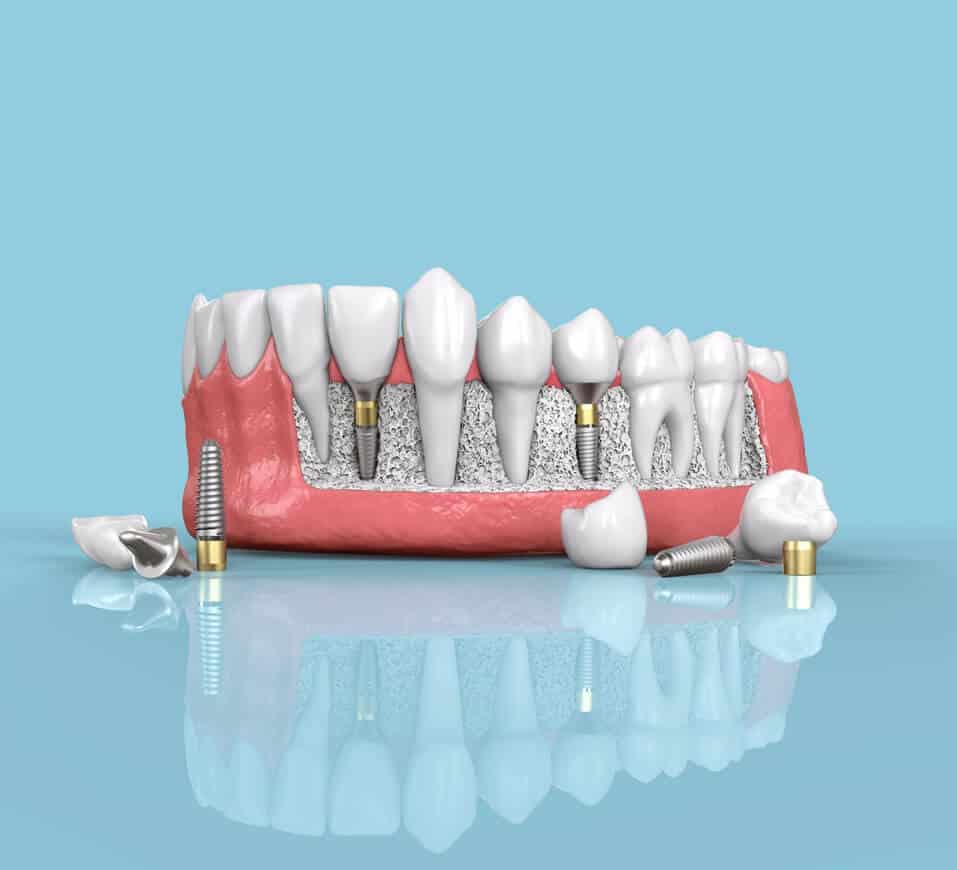 Dental Implants Treatment in Chicago - InSmyle Dental - Dentist Chicago