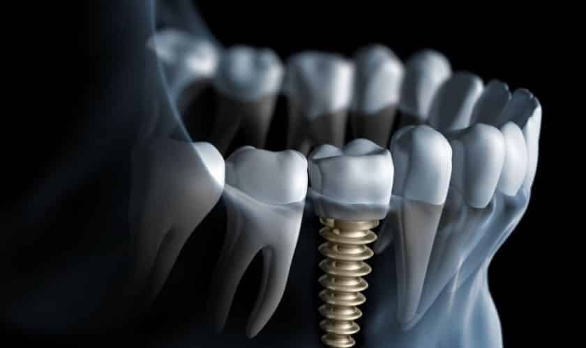 The Exciting Innovations of Dental Implants in 2024