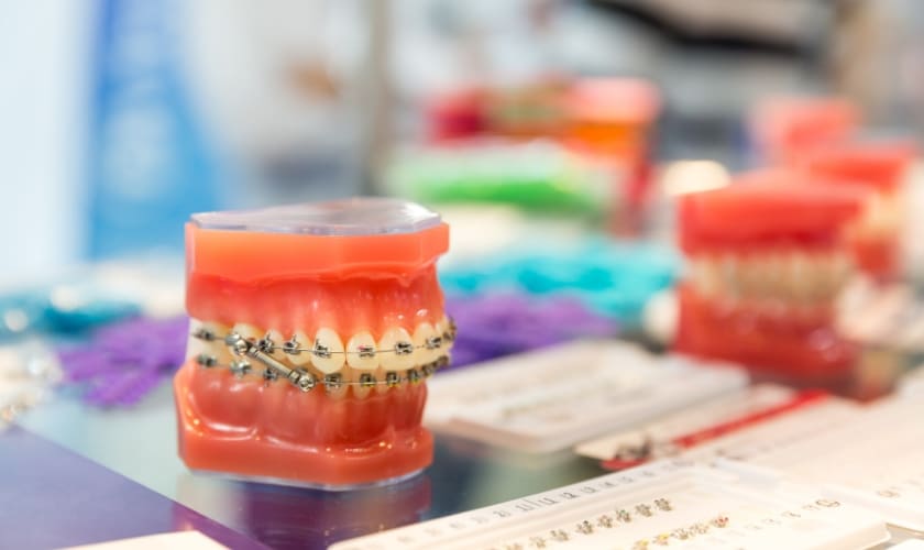 Can You Get Braces After a Gum Graft