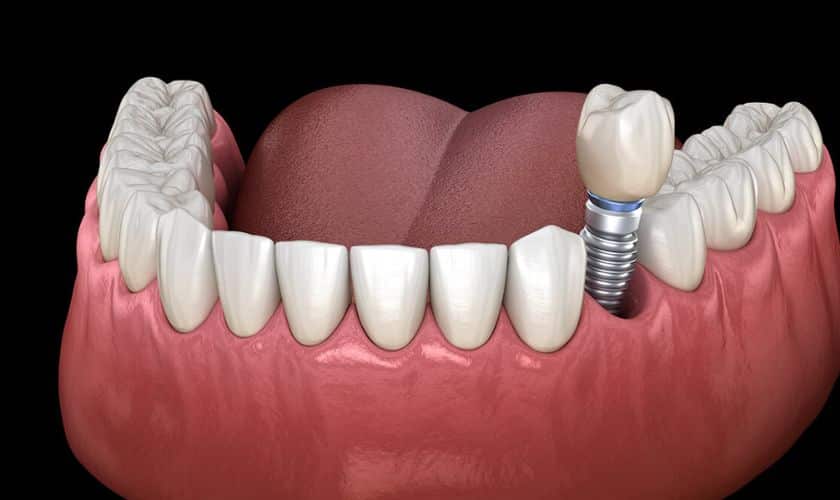 The Long-Term Influence Of Dental Implants