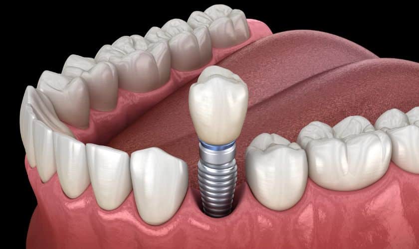 Emergency Care For Dental Implants